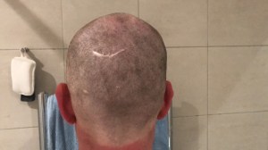 shaved head with scar